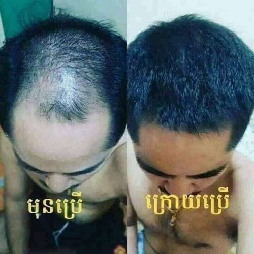 ផលិតផល kp hairស្រ្ពាយបាញ់បណ្ដុះសក់