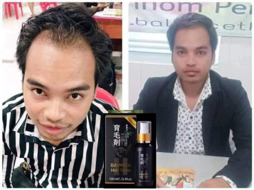 10 ថ្ងៃឈប់ជ្រុះ 15 ថ្ងៃបណ្ដុះសក់