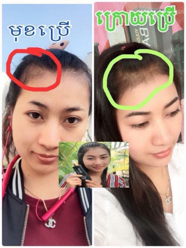 Balance H ផលិតផលបណ្តុះសក់