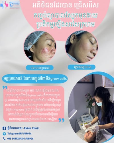 ព្យាបាលស្បែកមុខមុន ស្នាមមុន ជាំ អាចម៍រុយ