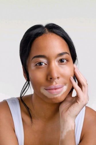 ថ្នាំលាបព្យាបាលជំងឺស្បែក vitiligo លើមុខ