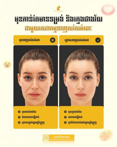 Thread lift & Filler