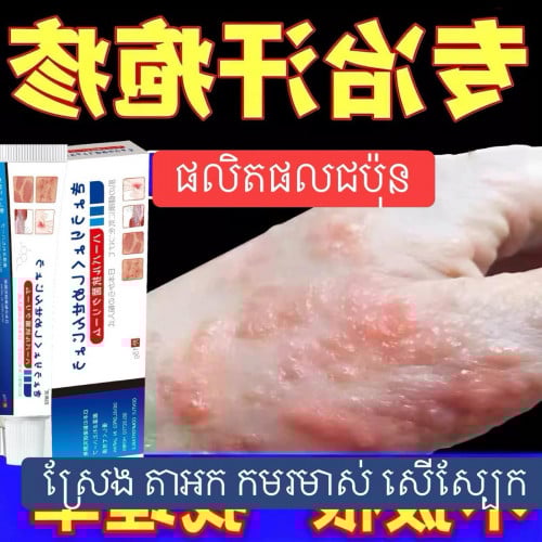 គ្រីមព្យាបាល​ ស្រែង​ តាអក​ កមរមាស់​ ផ្សិតសេីស្បែក