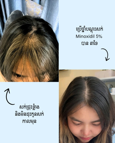 Minoxidil foam 5% brand Kirkland