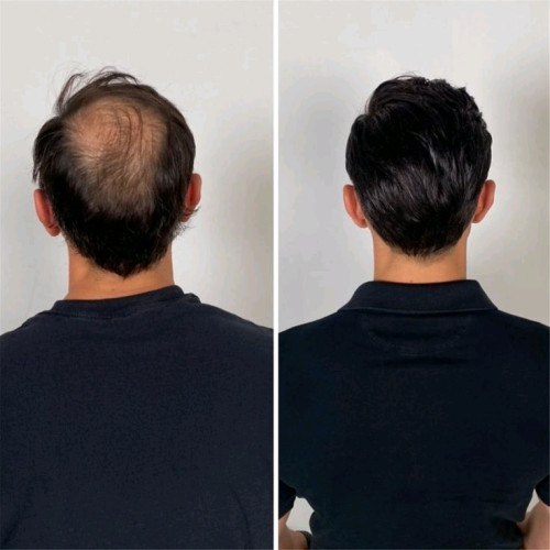 Minoxidil foam 5% brand Kirkland