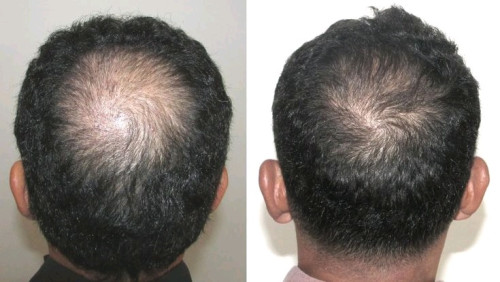 Minoxidil foam 5% brand Kirkland