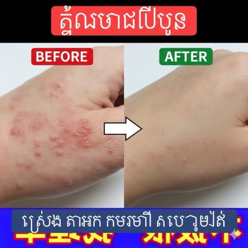 គ្រីមព្យាបាល​ ស្រែង​ តាអក​ កមរមាស់​ ផ្សិតសេីស្បែក
