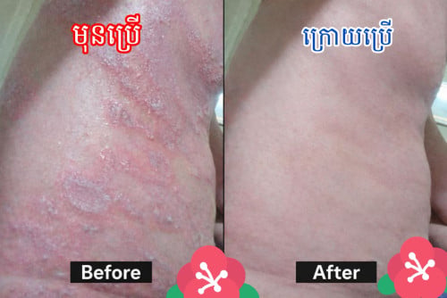 គ្រីមព្យាបាល​ ស្រែង​ តាអក​ កមរមាស់​ ផ្សិតសេីស្បែក