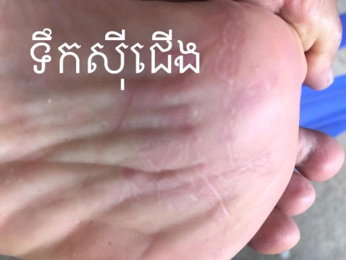 គ្រីមលាបបំបាត់ ទឹកស៊ីដៃ នឹងជើង ប្រេះដៃនឹងប្រេះជើង