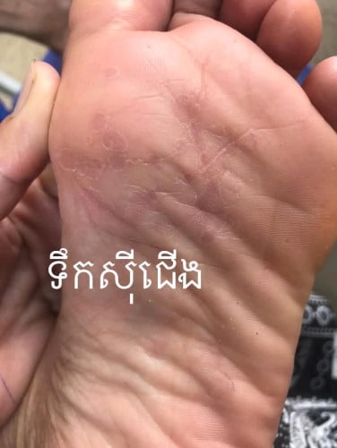 គ្រីមលាបបំបាត់ ទឹកស៊ីដៃ នឹងជើង ប្រេះដៃនឹងប្រេះជើង