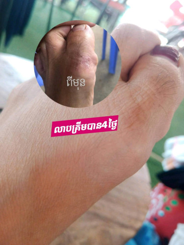 គ្រីមលាបបំបាត់ ទឹកស៊ីដៃ នឹងជើង ប្រេះដៃនឹងប្រេះជើង
