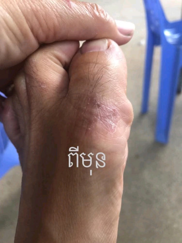 គ្រីមលាបបំបាត់ ទឹកស៊ីដៃ នឹងជើង ប្រេះដៃនឹងប្រេះជើង