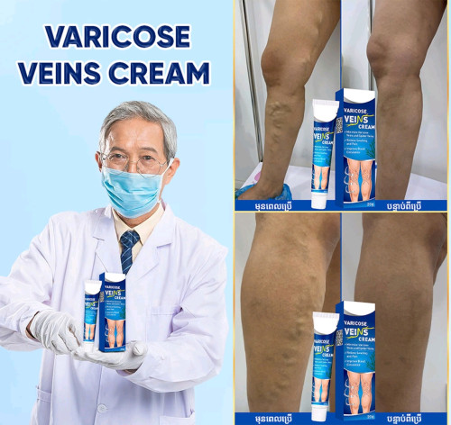 Varicose Veins លាបសសៃហើមប៉ោង