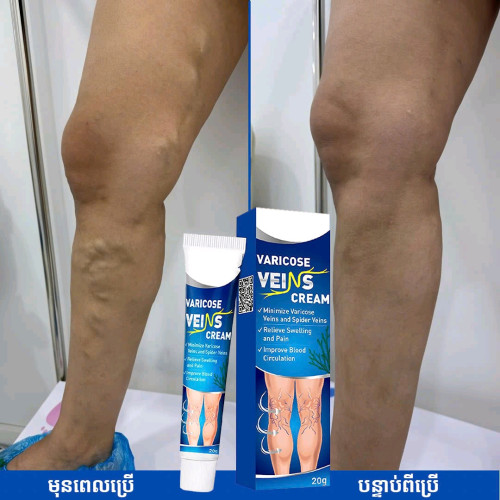 Varicose Veins លាបសសៃហើមប៉ោង