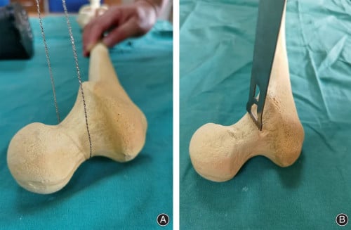 Gigli Saw Wire with Handle and Bailey Gigli Saw Guide Bend and Straight Orthopedics Instruments