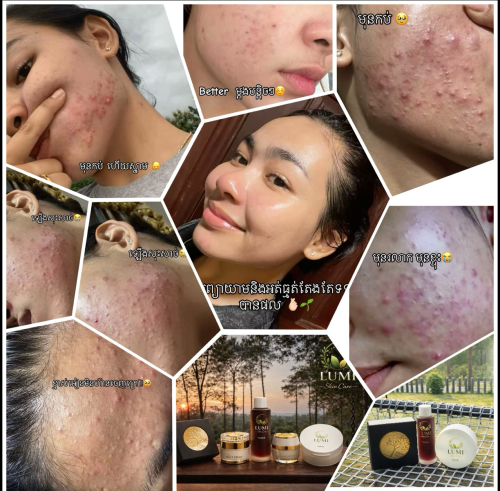 ឆុតមុខស្អាតបំបាត់មុន តូចធំ  និងស្នាម