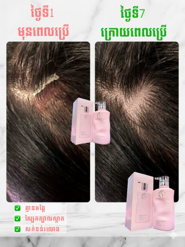 សាប៊ូកក់សក់ 𝐄&𝐄  បំបាត់អង្គែគ្មានសល់