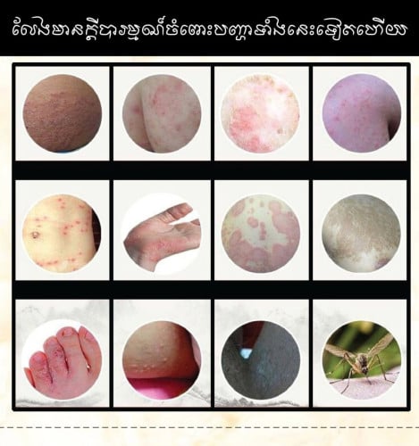 ថ្នាំលាបព្យាបាលរោគសើរស្បែក រមាស់ស្បែក កើតកន្ទួល ស្បែកក្រហម ផ្សិតស្បែក អាលែកស៊ីស្បែក